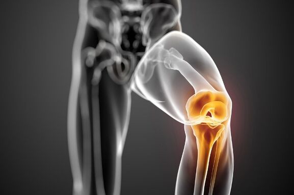 Arthrosis of the knee joint