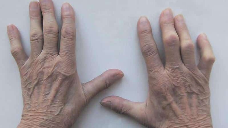 Methods for treating pain in the joints of the fingers