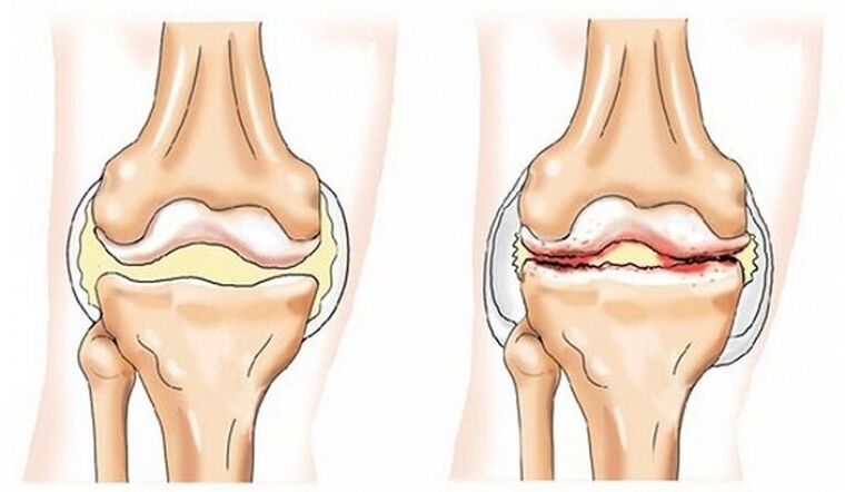 Healthy joint and joint affected by arthrosis