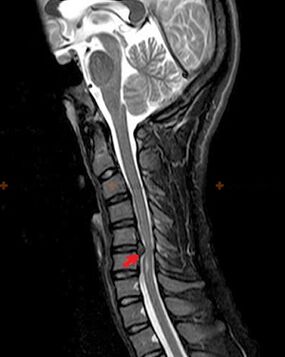 X-ray of the spine