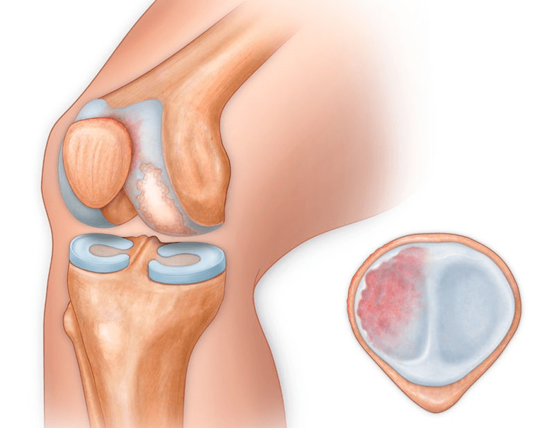 what does arthrosis of the knee joint look like