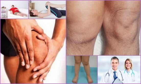 symptoms of knee arthrosis